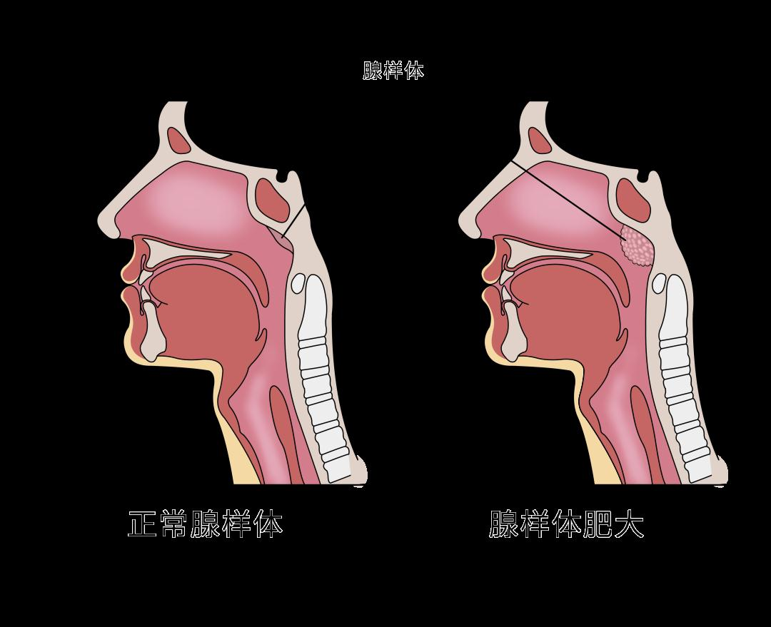 腺样体肥大
